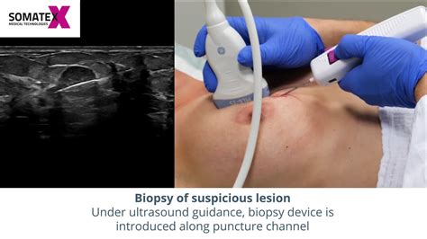 Breast biopsy .